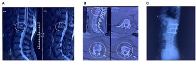 Case report: Ultrasound-guided multi-site electroacupuncture stimulation for a patient with spinal cord injury